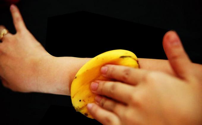 Μπανάνα δέρματος ανακουφίζει τέλεια φαγούρα από τα τσιμπήματα των κουνουπιών